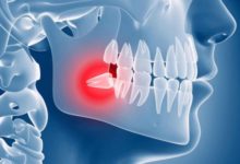Фото - Только боль и проблемы? Зачем нам зубы мудрости